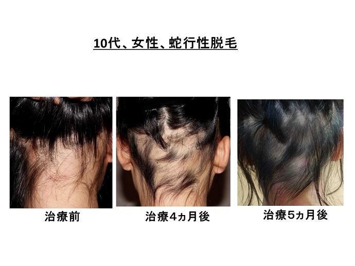 円形脱毛症　病院
